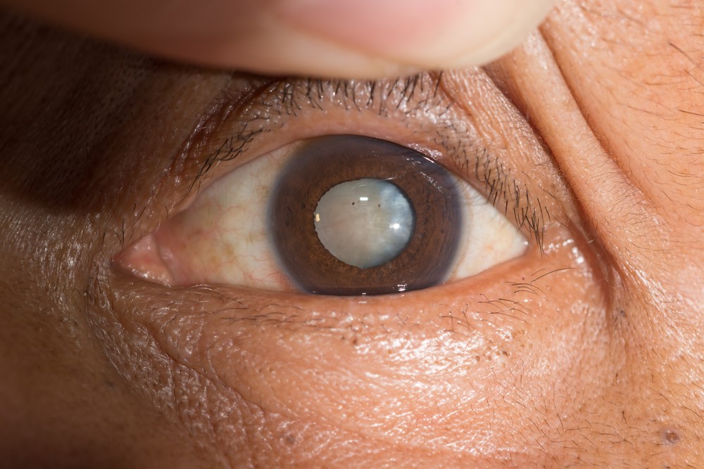 cataract