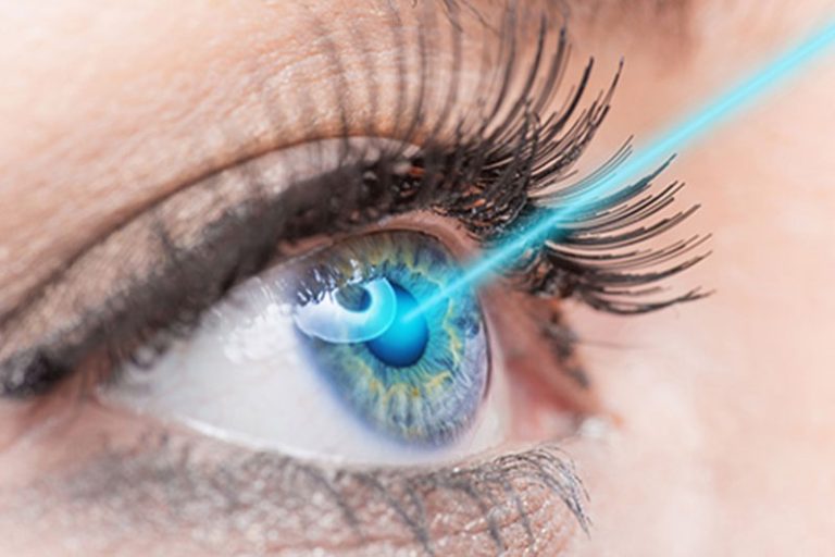 lasik